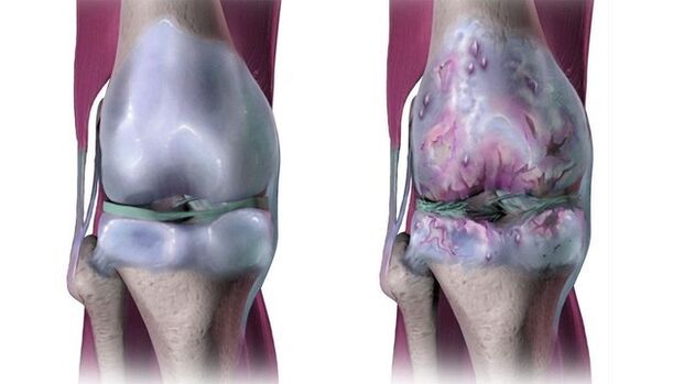 Articulação do joelho saudável e afetada por artrose