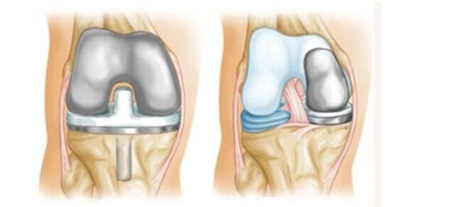 artroplastia para artrose da articulação do joelho