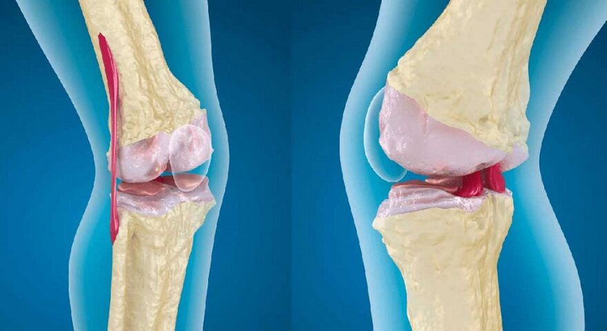 articulação saudável e artrose da articulação do joelho