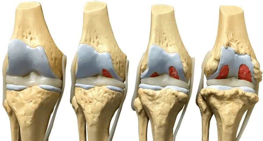 dano à articulação do joelho em diferentes estágios de desenvolvimento da artrose