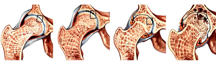 O grau de desenvolvimento de artrose da articulação do quadril