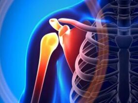 Articulação do ombro inflamada devido a artrose - uma doença crônica do sistema músculo-esquelético