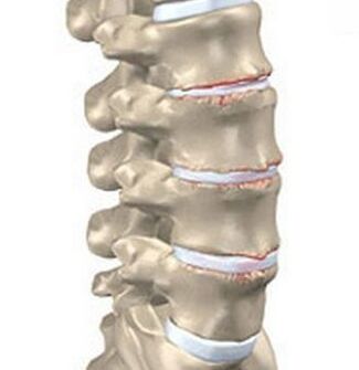 Cartilagem intervertebral