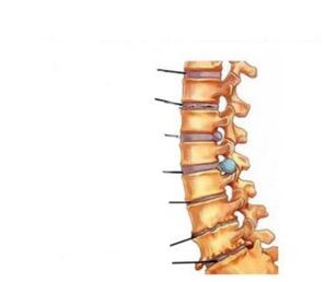 Sintomas de osteocondrose