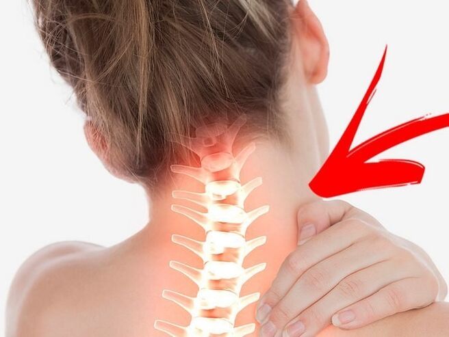 Compressão de raízes nervosas com osteocondrose cervical