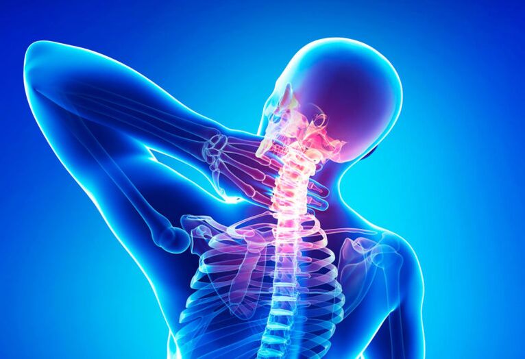 Osteocondrose da coluna cervical