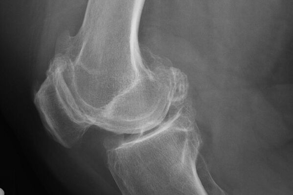 Métodos para diagnosticar a artrose do joelho