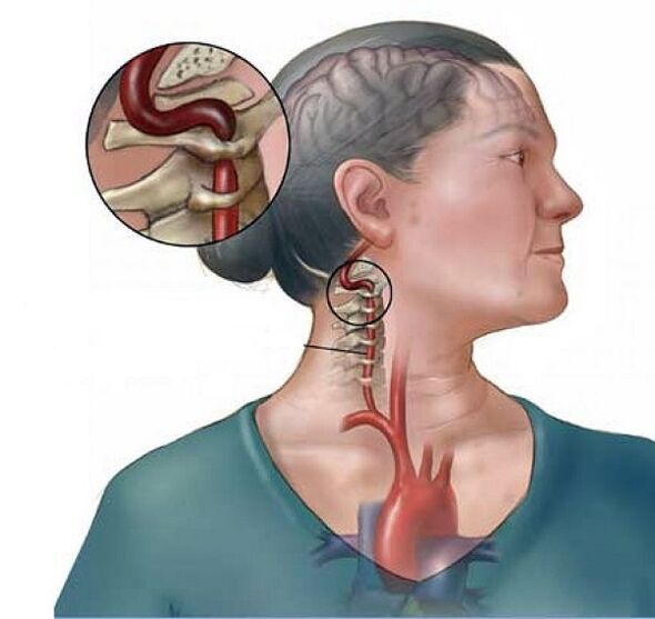síndrome da artéria vertebral com osteocondrose cervical