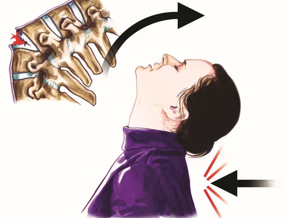 dano espinhal como causa de dor no pescoço