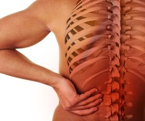 dor nas costas com osteocondrose lombar