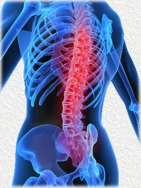 osteocondrose e métodos de seu tratamento